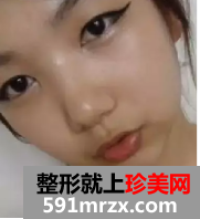 颧骨整形日记 变美需要勇气!