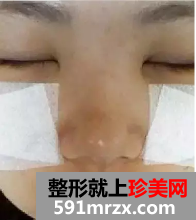 颧骨整形日记 变美需要勇气!