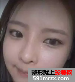 颧骨缩小和面部脂肪填充整形日记