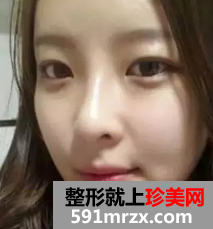 颧骨缩小和面部脂肪填充整形日记