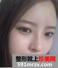 颧骨缩小和面部脂肪填充整形日记