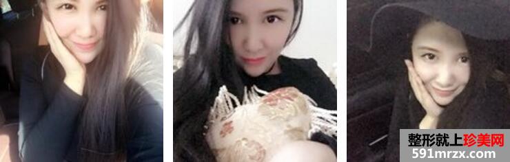 面部吸脂瘦脸术真实案例分享和恢复过程照片