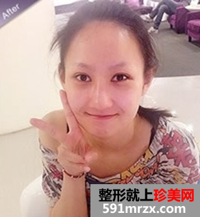 打瘦脸针和隆鼻前后对比图