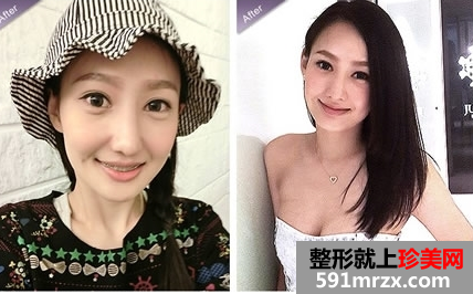 打瘦脸针和隆鼻前后对比图