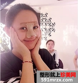 打瘦脸针和隆鼻前后对比图