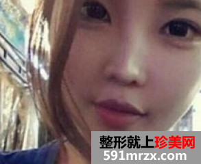 打完瘦脸针前后对比效果图及手术过程 打完瘦脸针前后对比效果图及手术过程