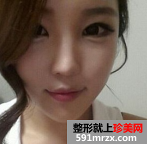 打完瘦脸针前后对比效果图及手术过程 打完瘦脸针前后对比效果图及手术过程
