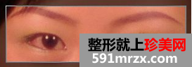 双眼皮整形日记 眼睛的大变身