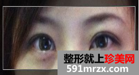 双眼皮整形日记 眼睛的大变身
