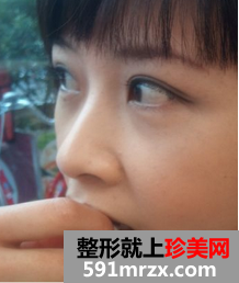 双眼皮整形日记 眼睛的大变身