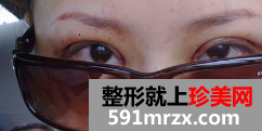 双眼皮整形日记 眼睛的大变身