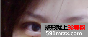 双眼皮整形日记 眼睛的大变身