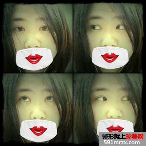 埋线双眼皮前后效果对比图和恢复过程