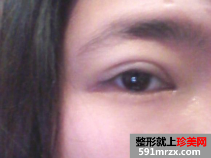 埋线双眼皮前后效果对比图和恢复过程