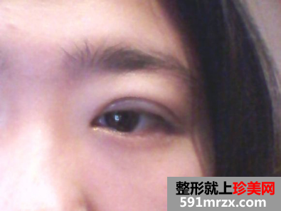 埋线双眼皮前后效果对比图和恢复过程