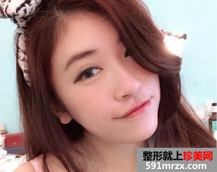 瘦脸针前后效果对比图
