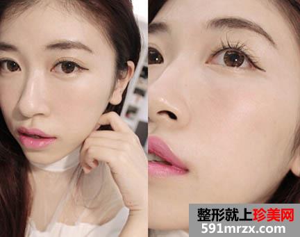 打完瘦脸针后1个月