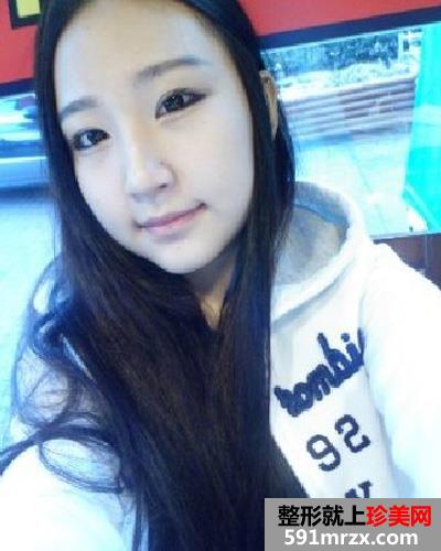 颧骨整形前后效果对比图和恢复过程