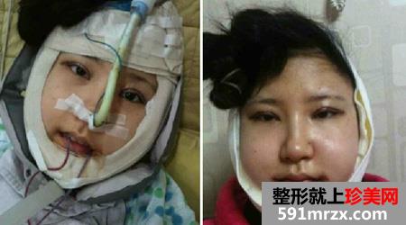 颧骨整形前后效果对比图和恢复过程