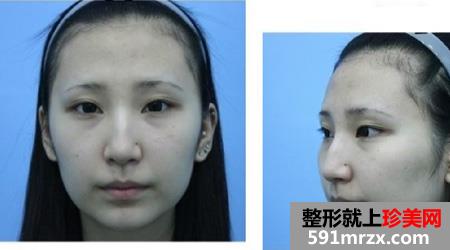 颧骨整形前后效果对比图和恢复过程