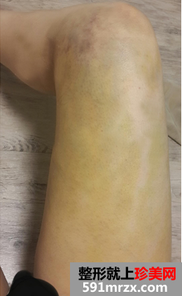 大腿吸脂恢复过程经历 告别了我的大象腿