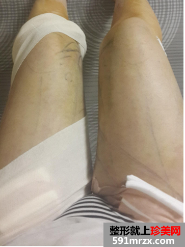 大腿吸脂恢复过程经历 告别了我的大象腿