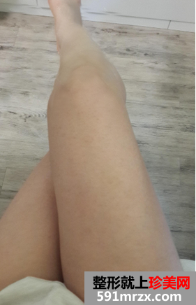 大腿吸脂恢复过程经历 告别了我的大象腿