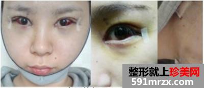 高级V轮廓术+开内外眼角前后效果对比图和恢复过程分享