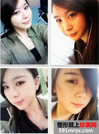 高级V轮廓术+开内外眼角前后效果对比图和恢复过程分享