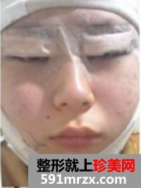 高级V轮廓术+开内外眼角前后效果对比图和恢复过程分享