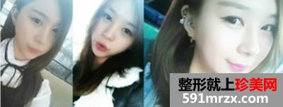 高级V轮廓术+开内外眼角前后效果对比图和恢复过程分享