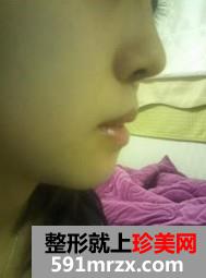 自体软骨隆鼻和下巴后缩前后效果对比图和恢复过程
