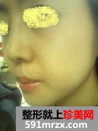 自体软骨隆鼻和下巴后缩前后效果对比图和恢复过程