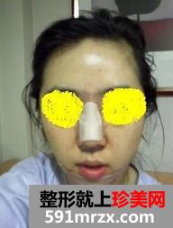 自体软骨隆鼻和下巴后缩前后效果对比图和恢复过程