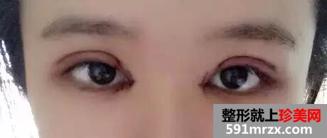开眼角加双眼皮后 我变身萌妹纸一枚!