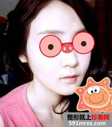 做了颧骨缩小+磨下颌骨变完美脸型