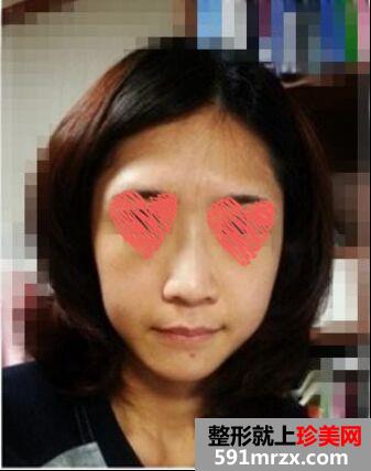 做了隆鼻+自体脂肪填充面部立马变身元气少女~