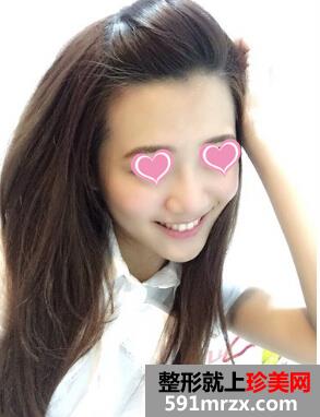 打玻尿酸后 苹果肌饱满鼻子也变翘了!