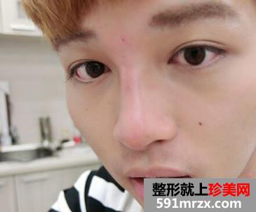 男生玻尿酸隆鼻后立马变身时尚欧巴