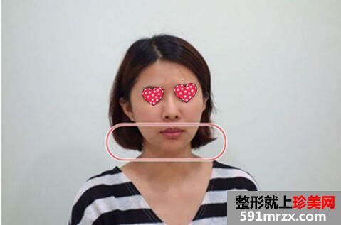 大龄宝妈做完音波拉皮变身美少女~