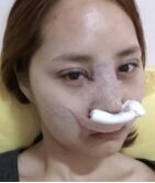 终于做了埋线双眼皮+隆鼻垫鼻尖手术