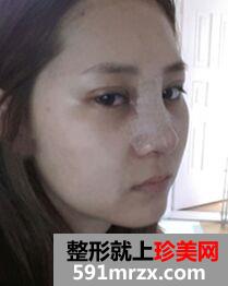 终于做了埋线双眼皮+隆鼻垫鼻尖手术