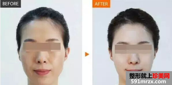 自体脂肪填充太阳穴前后对比效果图片