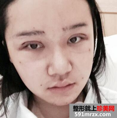 全脸脂肪填充+切开双眼皮真实案例恢复过程图分享~见证变美