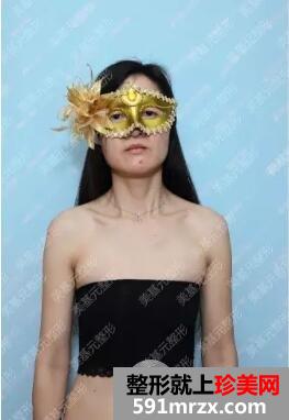武汉美基元汪福强假体隆胸案例对比效果图和项目价格表
