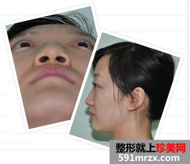 北京,明会红,国际,医疗,美容,机构,隆鼻,去眼袋,从平凡到惊艳