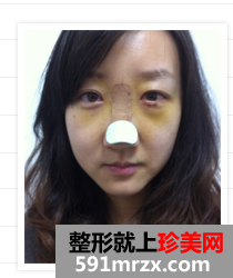 北京,明会红,国际,医疗,美容,机构,隆鼻,去眼袋,从平凡到惊艳