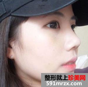 隆鼻+垫下巴恢复图+过程图