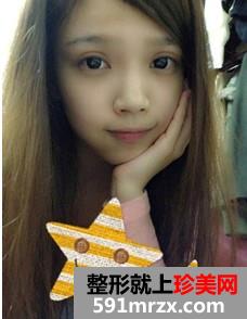 北京,华韩,整形,医院,余恩旭,开内眼角,前后,对比图