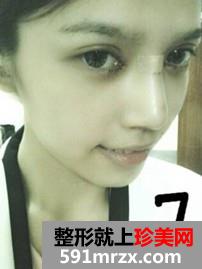 北京,华韩,整形,医院,余恩旭,开内眼角,前后,对比图